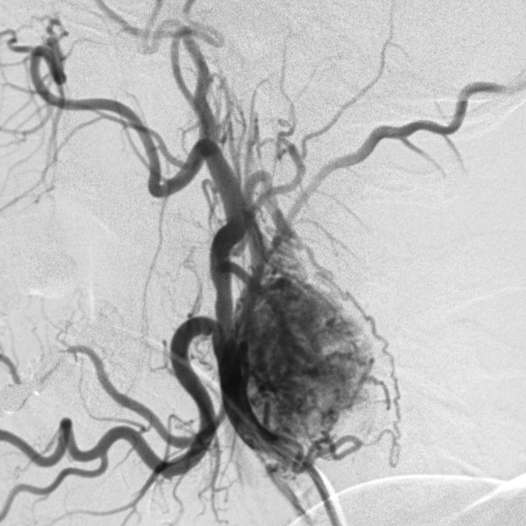 File:Carotid-body-tumour-on-angiography.jpg