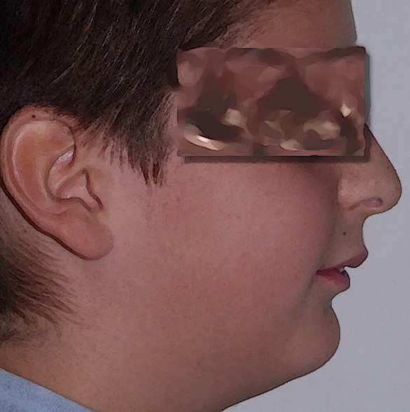 10-year-old boy with false maxillary prognathism