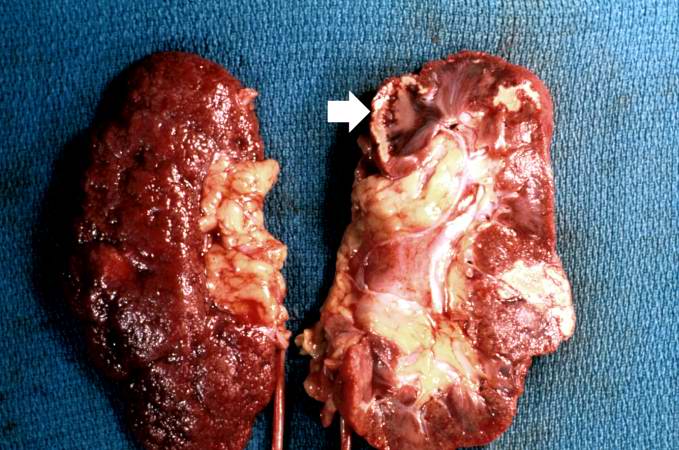 This gross photograph shows a kidney that has been transected longitudinally at autopsy. The cut surface (right) shows several areas of infarction. The most recent infarct is seen at the top left (arrow). The surface of the kidney (left) shows a marked nodularity and roughening from scarring due to chronic hypertension.
