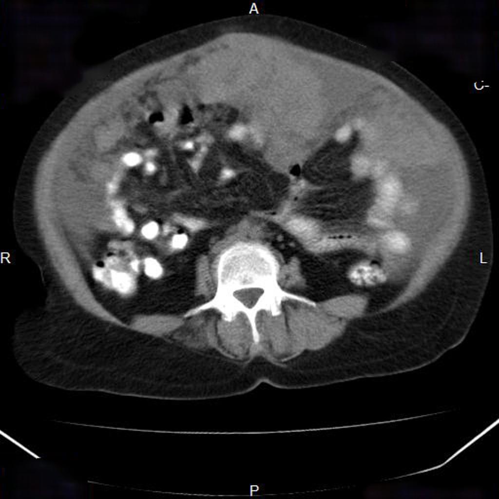 File:Ovarian-cancer-with-peritoneal-carcinomatosis-1.jpg