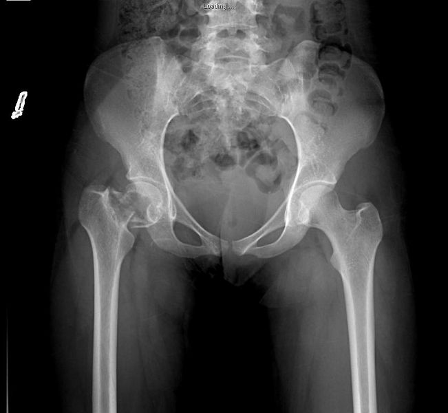 File:Pathologic fracture hip x-ray.jpg