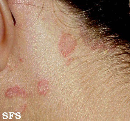 File:Seborrhoeic dermatitis 09.jpeg