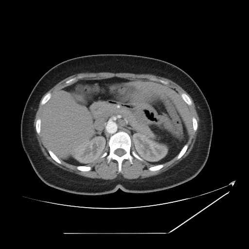 File:Situs-ambiguous-asplenia-syndrome-with-bilateral-right-sidedness CT.jpg