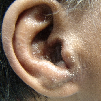 Allergic otitis externa, a reaction to Neomycin. The skin of the external auditory meatus, concha, incisura intertragica is swollen, bumpy and itchy.[4]
