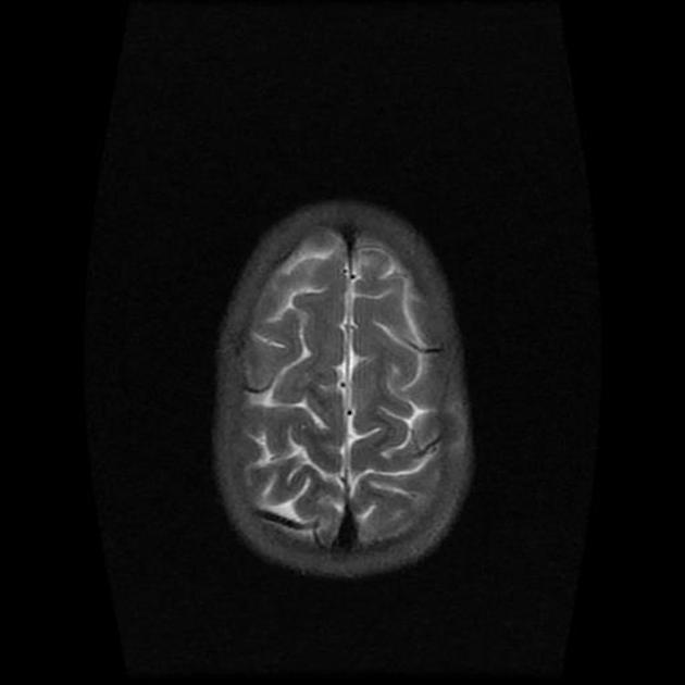 File:Burkitt's tumor MRI 02.jpg