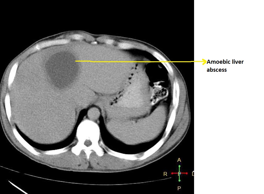 Amoebic liver abscess