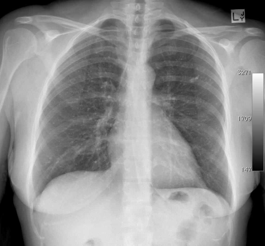 Innumerable small calcific densities throughout both lungs in a patient with a documented history of varicella pneumonia. [3]