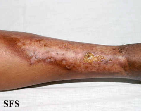 . Adapted from Dermatology Atlas.[1]