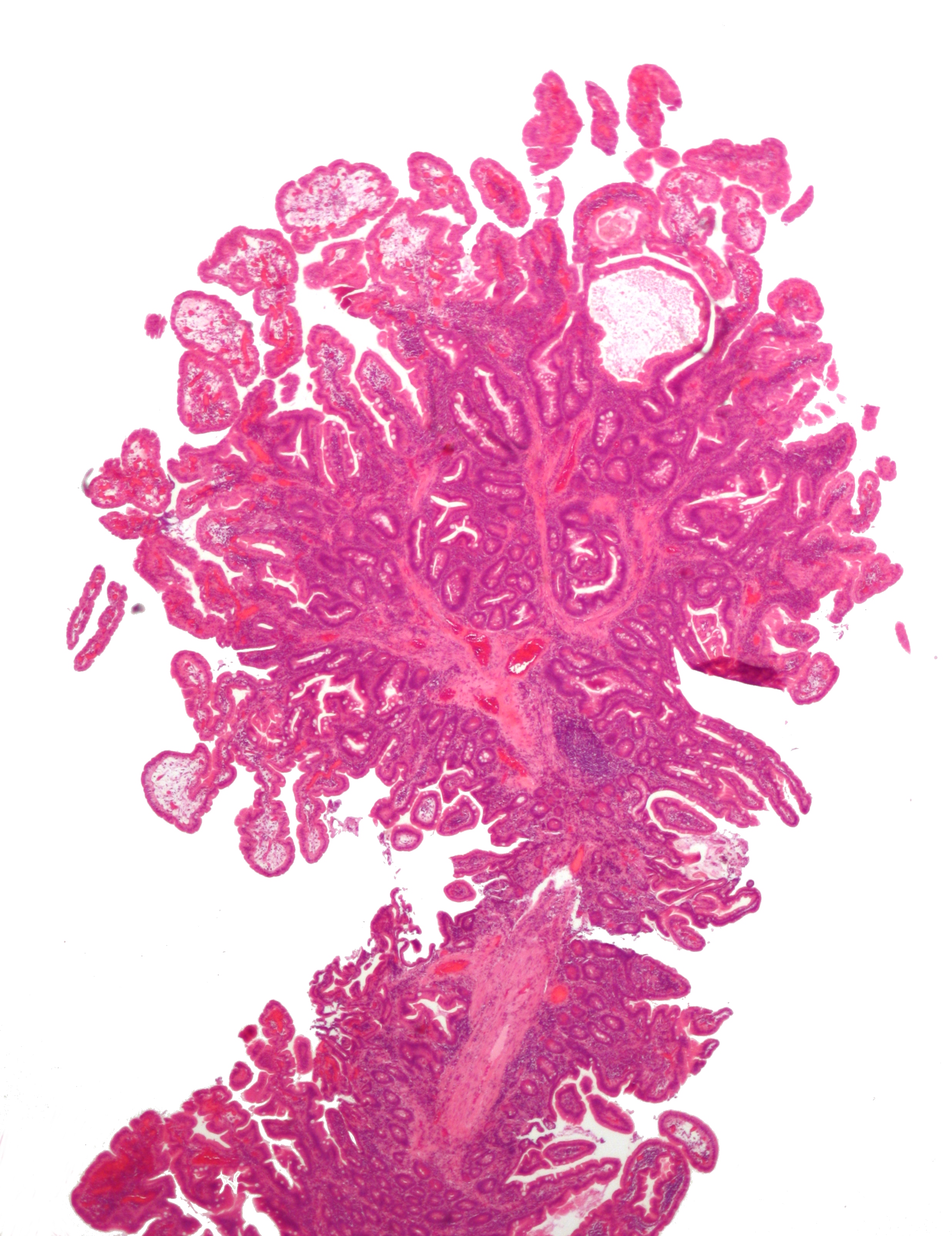 File:Peutz-Jeghers syndrome polyp .jpg