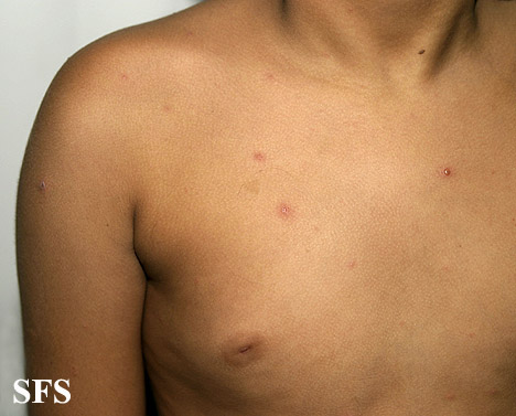 Varicella From Public Health Image Library (PHIL). [3]