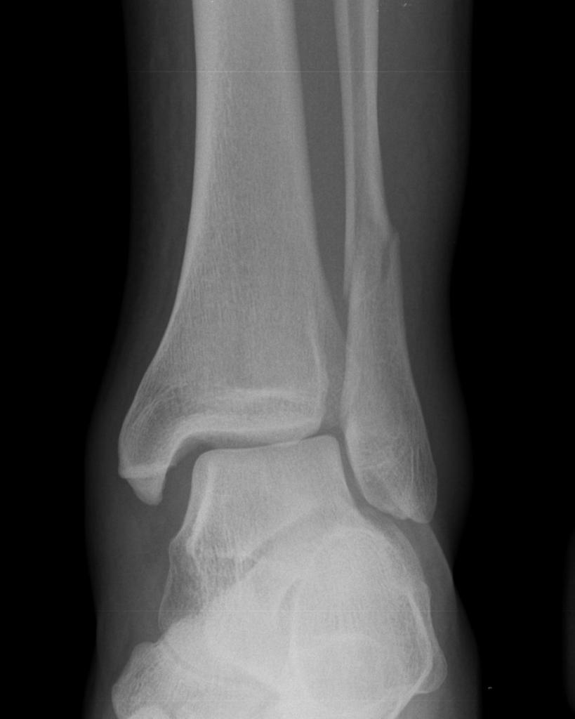 Ankle-fracture-weber-C