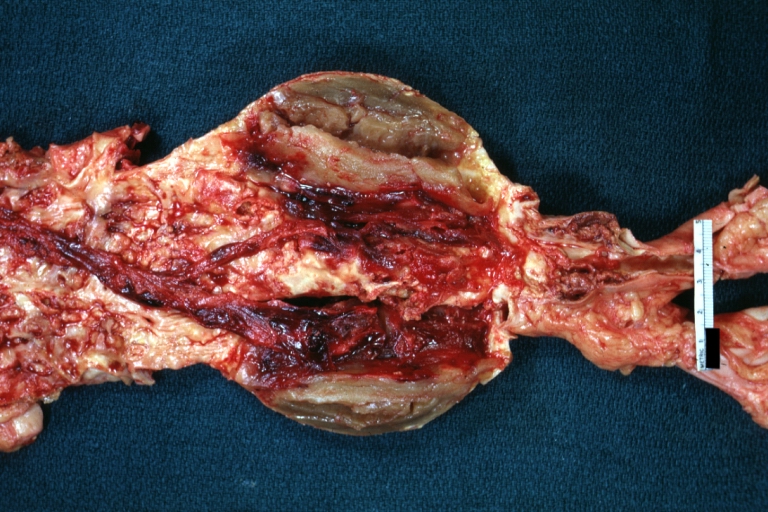 Abdominal Aneurysm: Gross, natural color, an opened aneurysm showing quite well laminated thrombus