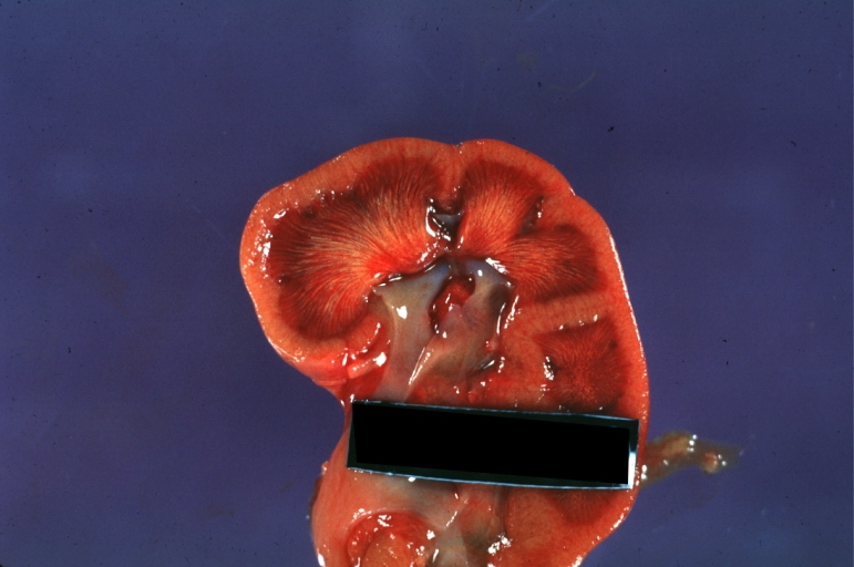 Kidney: Uric Acid Deposition: Gross, infant kidney with excellent uric acid streaks