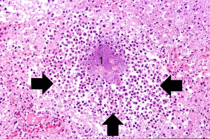 A high-power photomicrograph of lung from this case demonstrates a small abscess full of inflammatory cells (primarily neutrophils) (arrows). There is a bacterial colony in the center of this abscess (1).