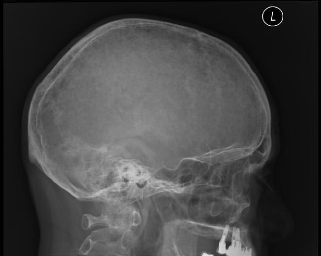 X ray showing hair on end appearance.