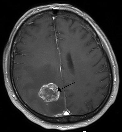 Brain metastasis in the right cerebral hemisphere from lung cancer shown on T1-weighted magnetic resonance imaging with intravenous contrast.[3]