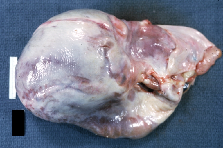 Epicardial Scarring: Gross, marked thickening of epicardium, sugar-coated appearance