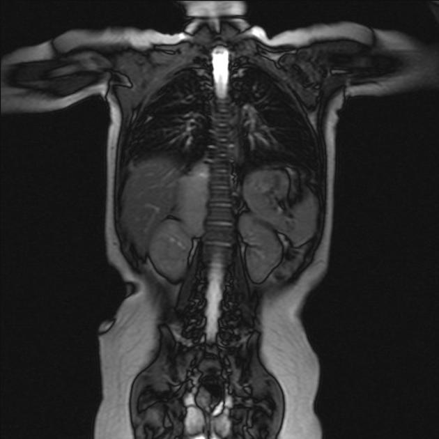 Neuroblastoma observed on coronal MRI of the abdomen as a well defined mass lesion located at the right suprarenal region[4]