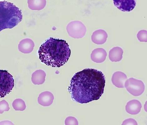 Peripheral blood showing mast cell leukemia.[6]