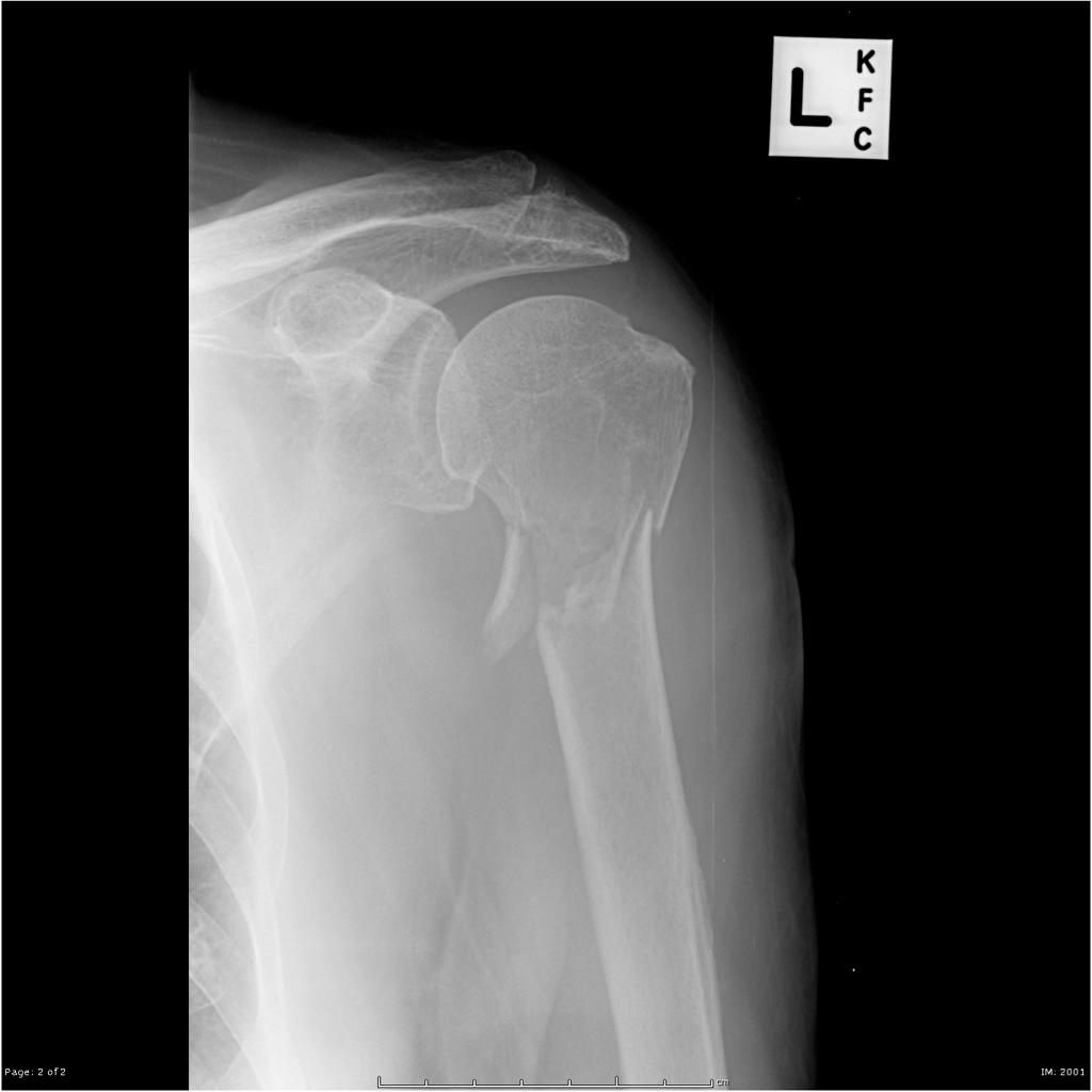 Surgical-neck-of-humerus-fracture.jpg