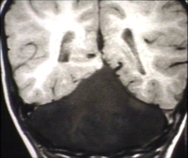 BRAIN: ARNOLD CHIARI TYPE IV; T1 (MRI)