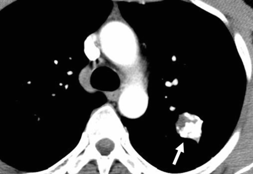 File:Calcified lung nodule white arrow.png