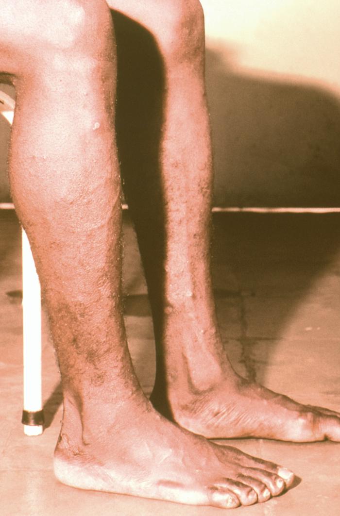 Right lateral surface of a patient’s right lower leg and foot with classic maculopapular rash of chickenpox. From Public Health Image Library (PHIL). [23]