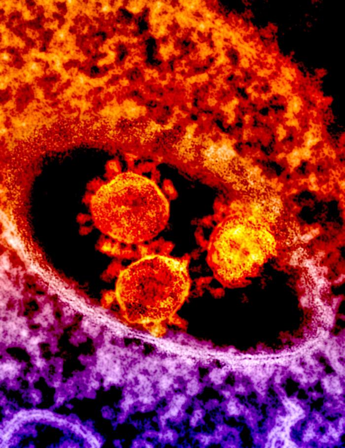 TEM reveals ultrastructural details exhibited by a number of red-colored, spherical-shaped Middle East Respiratory Syndrome Coronavirus (MERS-CoV) virions. From Public Health Image Library (PHIL). [15]
