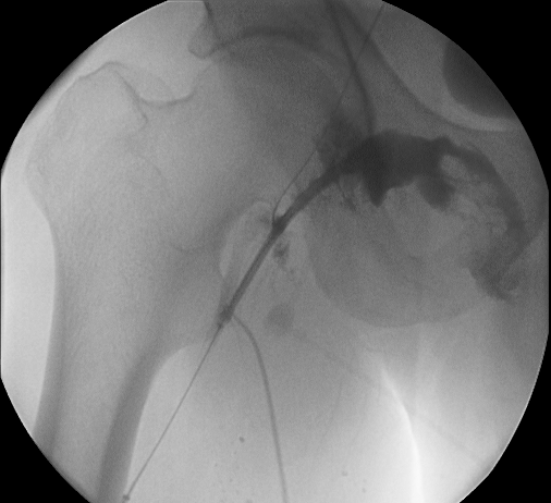 Complication during right femoral artery puncture. Copyleft image courtesy of C. Michael Gibson.