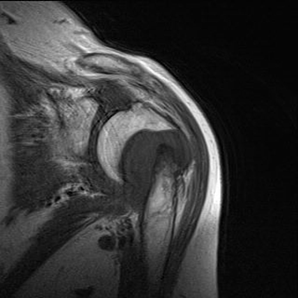 File:Non-united-proximal-humeral-fracture (1).jpg