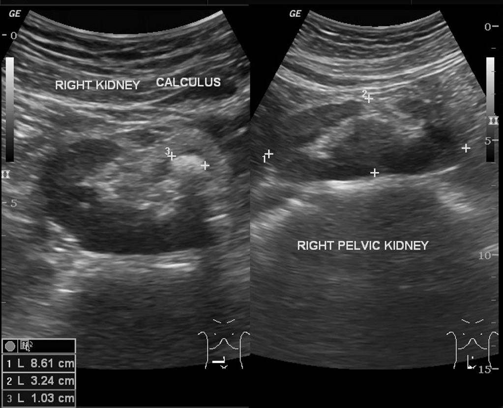 File:Pelvic-kidney.jpg