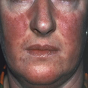 Face psoriasis, courtesy of https://aloeworldnorfolk.wordpress.com/tag/psoriasis/