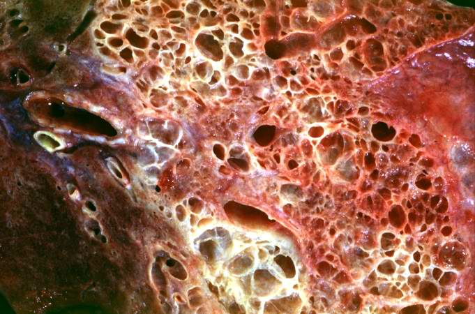 This is a closer view of the cut section of lung from this patient. Note the extensive fibrosis and the severe emphysematous changes.