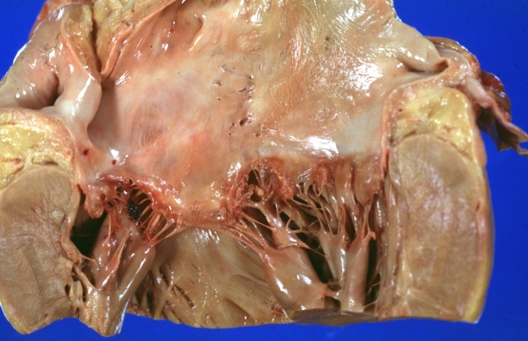 Lupus Erythematosus Libman Sacks Endocarditis: Gross natural color mitral valve small lesions but cause much trouble in form of TIAs and terminally multiple hemorrhagic brain infarcts