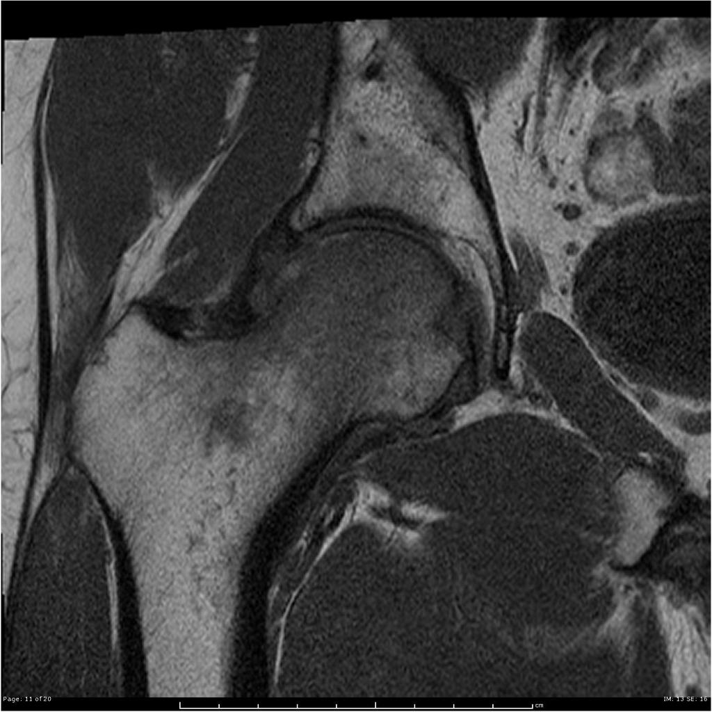 File:Transient-osteoporosis-of-the-hip-underlying-subchondral-fracture (2).jpg