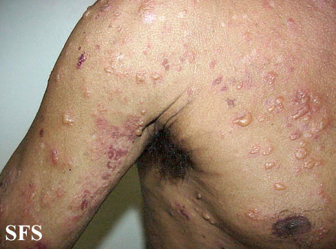 Bullous pemphigoid. Permission from Dermatology Atlas.[1]