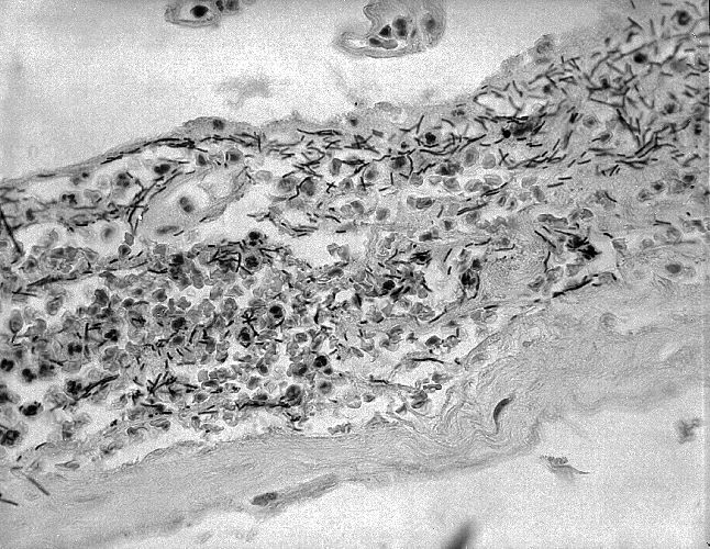 "Photomicrograph of meninges demonstrating the presence of Bacillus anthracis in a case of fatal inhalation anthrax.”Adapted from Public Health Image Library (PHIL), Centers for Disease Control and Prevention.[21]