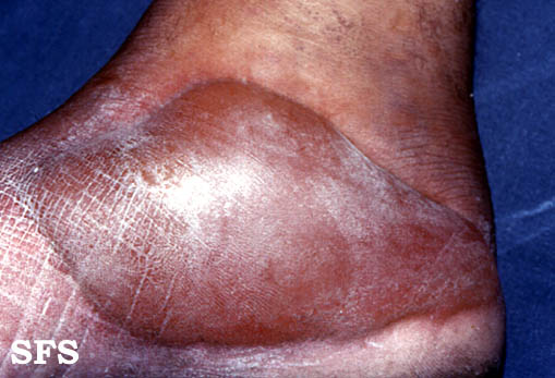 url = http://www.atlasdermatologico.com.br/disease.jsf?diseaseId=150>