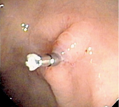 Same ulcer seen after endoscopic clipping]]