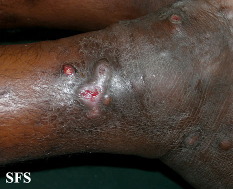 File:Lepromatous leprosy52.jpg