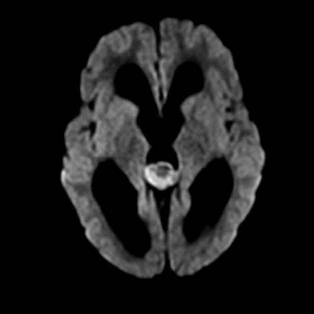 MRI image of pineoblastoma demonstrating restricted diffusion on DWI.[24]