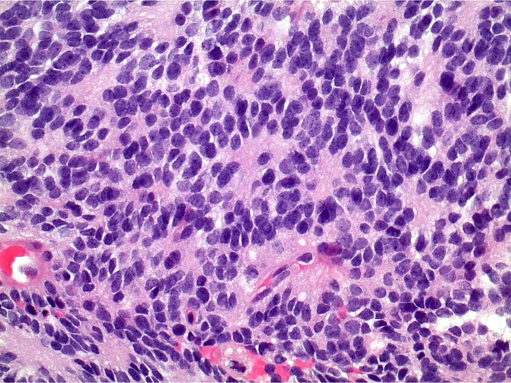 Paraffin sections show fragments of a densely hypercellular tumor. Tumor cells have small round, oval, and angulated hyperchromatic nuclei and delicate processes which show strong immunostaining for neurofilament protein (NFP). Tumor cells are arranged in diffuse sheets. Prominent Homer-Wright rosettes are observed in several areas. Scattered mitotic figures are identified. No areas of necrosis are observed.[8]
