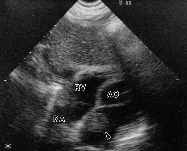 Transthoracic echocardiogram (short axis, parasternal view) through the level of the atria shows a round, echogenic mass (arrowhead) within the left atrium attached to the atrial septum. The patient was a 44-year-old woman with chest pain and left atrial myxoma. AO = aorta; RA = right atrium; RV = right ventricle. Image courtesy of Professor Peter Anderson DVM PhD and published with permission © PEIR, University of Alabama at Birmingham, Department of Pathology