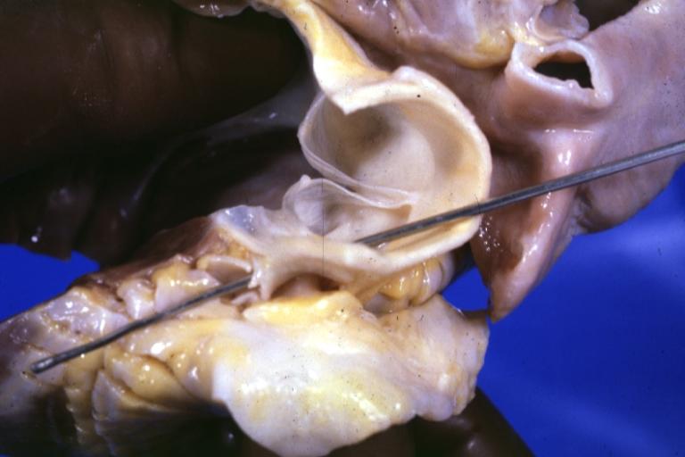 Gross aortic valve origin of left coronary artery from right sinus of Valsalva sudden unexpected death