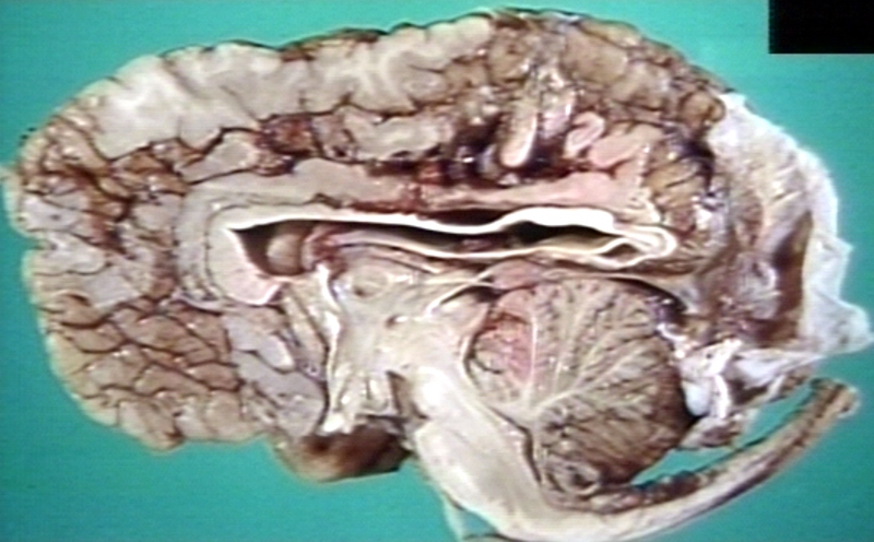Brain: Arnold Chiari Malformation