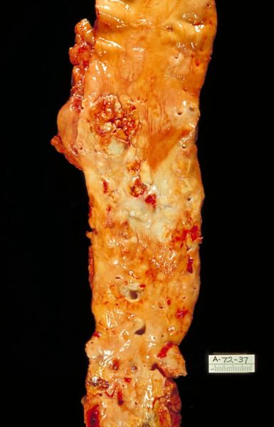 Severe atherosclerosis of the aorta. Autopsy specimen.