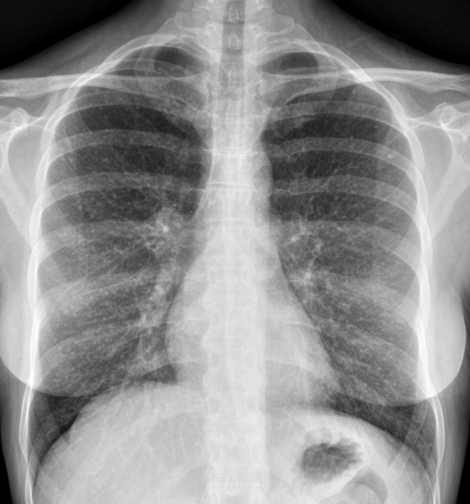 Miliary lung nodules consistent with prior and healed varicella pneumonia. [4]