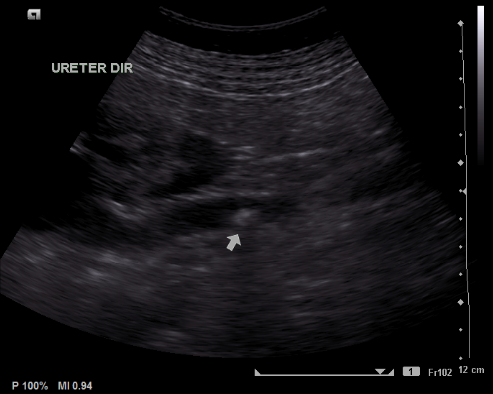 File:Hydronephrosis-due-to-ureteral-stones 2.png