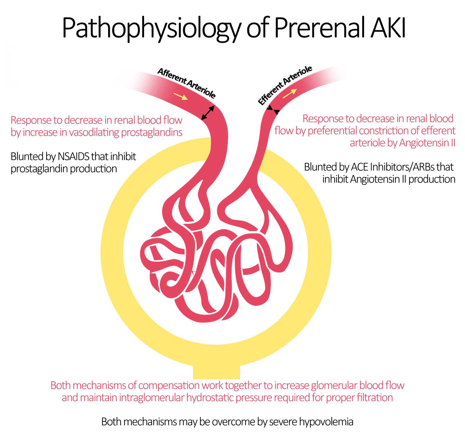 File:Pathophysiology of Prerenal AKI.jpeg