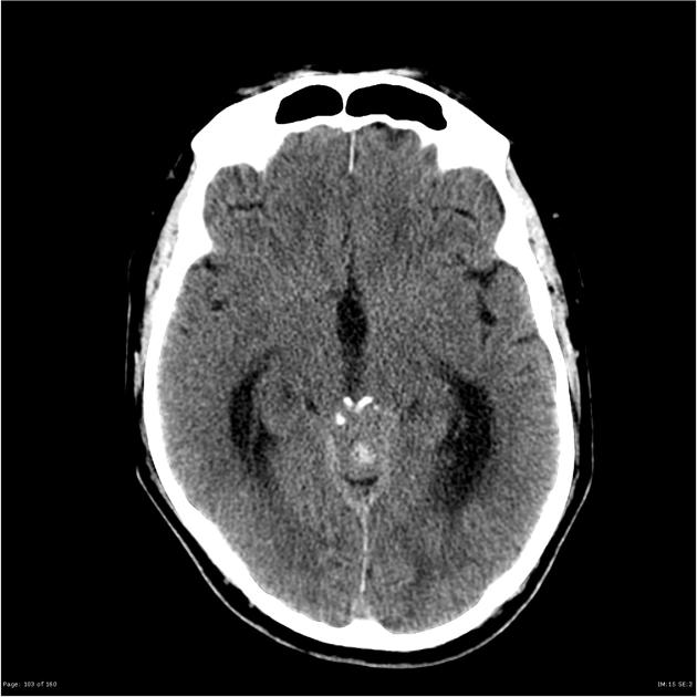 Pre-contrast CT scan demonstrating moderate internal obstructive hydrocephalus, due to a large, partially calcified, dense mass which appears to be centered upon the pineal gland. The quadrigeminal plate appears anteriorly displaced and the aqueduct obliterated. It does not appear to have an intimate relationship with the tentorium.[21]